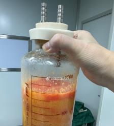 厦门水动力吸脂手术要做多久？